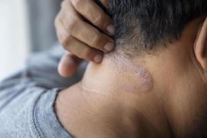 Los hombres asiáticos de piel oscura sufren de dermatitis en el cuero cabelludo debido a los hongos que causan la humedad. picor fúngico. enfermedades de la piel-alergias, psoriasis, eczema, dermatitis. foto