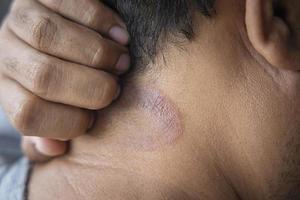 Los hombres asiáticos de piel oscura sufren de dermatitis en el cuero cabelludo debido a los hongos que causan la humedad. picor fúngico. enfermedades de la piel-alergias, psoriasis, eczema, dermatitis. foto