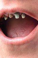 The woman opened her mouth wide, and showed her crooked and rotten teeth close up photo