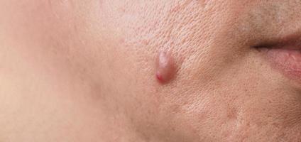 Absceso de quiste de acné grande o área inflamada de úlcera dentro del tejido de la piel de la cara. foto