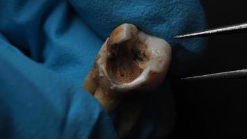 Tooth decay and dentist hand with glove and black background. photo