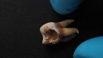 Tooth decay and dentist hand with glove and black background. photo