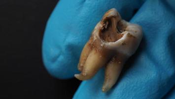 Tooth decay and dentist hand with glove and black background. photo