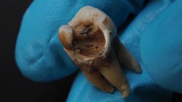 Tooth decay and dentist hand with glove and black background. photo