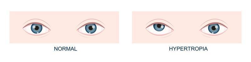 Hypertropia. Vertical strabismus before and after surgery. Human eyes healthy and with upward gaze position. Double vision