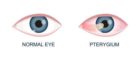 Eye healthy and with pterygium. Conjunctival degeneration before and after surgery. Eye disease. Human organ of vision with pathology vector