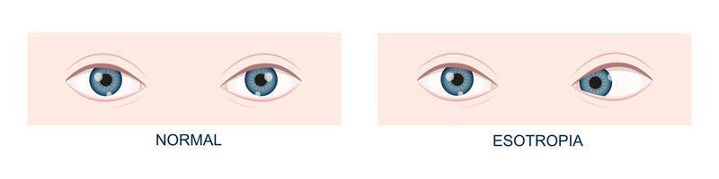 Esotropia. Horizontal strabismus before and after surgery. Eye misalignment, cross-eyed condition. Human eyes healthy and with inward gaze position. Double vision vector