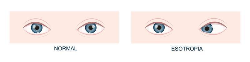 Esotropia. Horizontal strabismus before and after surgery. Eye misalignment, cross-eyed condition. Human eyes healthy and with inward gaze position. Double vision vector