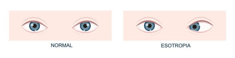 Esotropia. Horizontal strabismus before and after surgery. Eye misalignment, cross-eyed condition. Human eyes healthy and with inward gaze position. Double vision