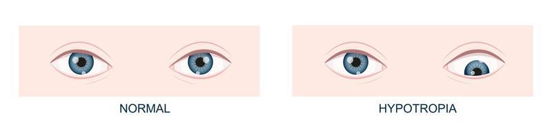 Hypotropia. Vertical strabismus. Human eyes healthy and with downward gaze position. Double vision