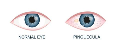 Eye healthy and with pinguecula. Conjunctival degeneration before and after surgery. Eye disease. Human organ of vision with pathology vector