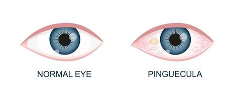 ojo sano y con pinguécula. degeneración conjuntival antes y después de la cirugía. enfermedad ocular. órgano humano de la visión con patología vector