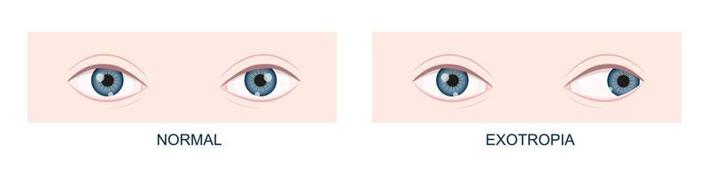 Exotropia. Horizontal strabismus before and after surgery. Eye misalignment, cross-eyed condition. Human eyes healthy and with outward gaze position. Double vision