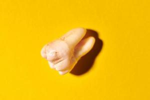 Wisdom tooth with tooth decay, yellow background photo