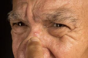 Man trying to pop a pimple on the bridge or his nose. photo