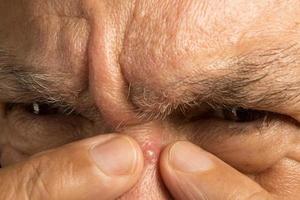 Man trying to pop a pimple on the bridge or his nose. photo