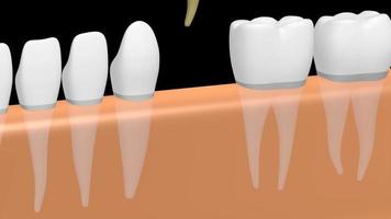 3D Dental Implant - Tooth Implant - on Black Background video