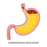 Gastroesophageal reflux disease and heartburn illustration vector