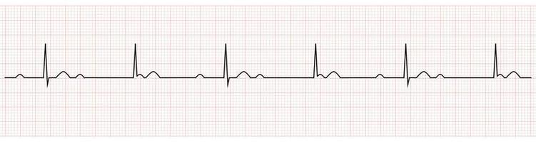 EKG Showing third degree or complete av block vector