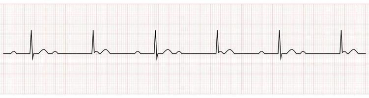 electrocardiograma que muestra bloqueo av completo o de tercer grado vector