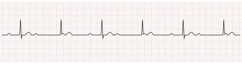 EKG Showing third degree or complete av block