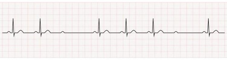 EKG Showing second degree av block mobitz II vector