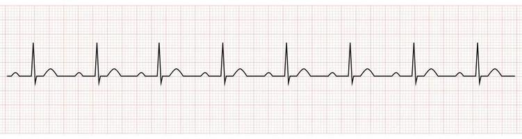 EKG Showing PR prolong which is Sign of First degree AV Block vector