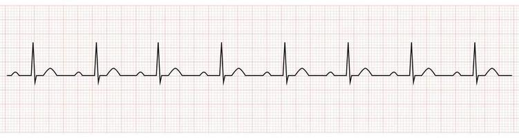 EKG Showing PR prolong which is Sign of First degree AV Block vector