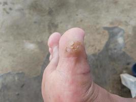 selectively focus on the calluses of the big toe due to shoe friction photo