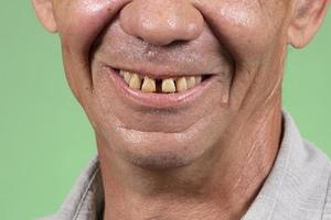 parte de la cara con feos dientes amarillos y escasos. problemas dentales de los dientes anteriores en una persona mayor. boca sonriente de un hombre con dientes amarillos torcidos de cerca foto