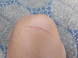scratched or injured knee. photo