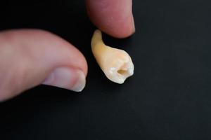 Human hand close to a extracted cheektooth photo