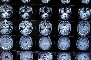 mri with brain tumor. Magnetic resonance imaging. photo