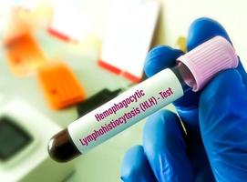 Blood sample for HLH or Hemophagocytic Lymphohistiocytosis, a rare fatal condition in which white blood cells damage organs, including bone marrow, liver, spleen. photo