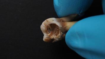 Tooth decay and dentist hand with glove and black background. Macro shot of a decayed teeth till root after extraction of dentist. Real tooth anatomy due lack of dental care. Top view of caries teeth photo