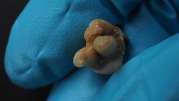 Tooth decay and dentist hand with glove and black background. Macro shot of a decayed teeth till root after extraction of dentist. Real tooth anatomy due lack of dental care. Top view of caries teeth photo