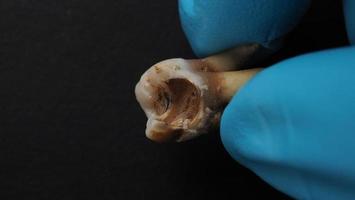 Tooth decay and dentist hand with glove and black background. Macro shot of a decayed teeth till root after extraction of dentist. Real tooth anatomy due lack of dental care. Top view of caries teeth photo