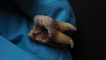 Tooth decay and dentist hand with glove and black background. Macro shot of a decayed teeth till root after extraction of dentist. Real tooth anatomy due lack of dental care. Top view of caries teeth photo