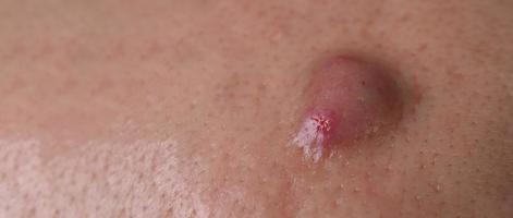 Big Acne Cyst Abscess or Ulcer Swollen area within face skin tissue. photo