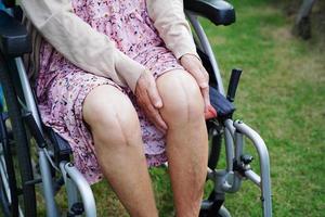 Asian elderly woman patient with scar knee replacement surgery in hospital. photo