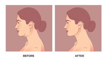 Liposucción de papada. antes y después de braquioplastia, liposucción o cirugía plástica, transformación de la forma del cuerpo de la mujer, grasa para adaptarse. vector