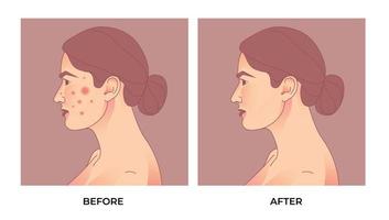 women face with problematic skin. Acne treatment before and after. Skin care concept. vector