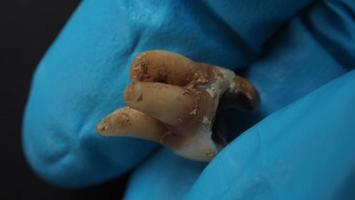 Tooth decay and dentist hand with glove and black background. Macro shot of a decayed teeth till root after extraction of dentist. Real tooth anatomy due lack of dental care. Top view of caries teeth photo