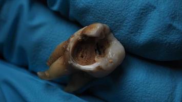 Tooth decay and dentist hand with glove and black background. Macro shot of a decayed teeth till root after extraction of dentist. Real tooth anatomy due lack of dental care. Top view of caries teeth photo