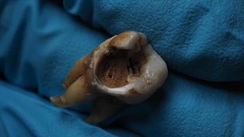 Tooth decay and dentist hand with glove and black background. Macro shot of a decayed teeth till root after extraction of dentist. Real tooth anatomy due lack of dental care. Top view of caries teeth photo