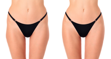 Closeup shot of female thighs before and after treatment, isolated png