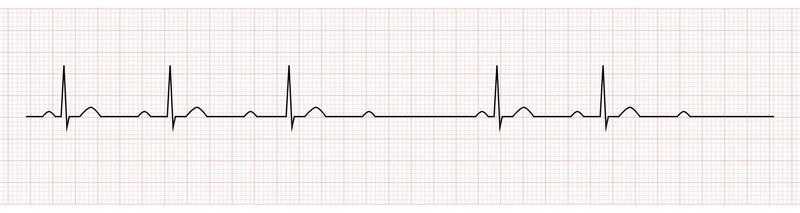 EKG Showing second degree av block mobitz I