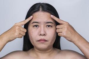 Asian adult woman face has freckles, large pores, blackhead pimple and scars problem from not take care for a long time. Skin problem face isolated white background. Treatment and Skincare concept photo