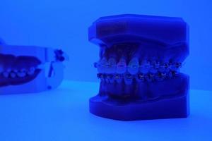 dental tratamiento modelo con metal soporte arco de alambre foto
