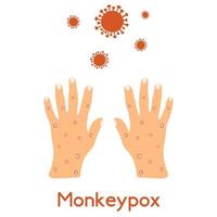 Monkeypox symptoms, hand skin rashes, blisters and purulent formations. Skin disease caused by a virus, chicken pox, acne, pustule in flat style isolated on white background. vector